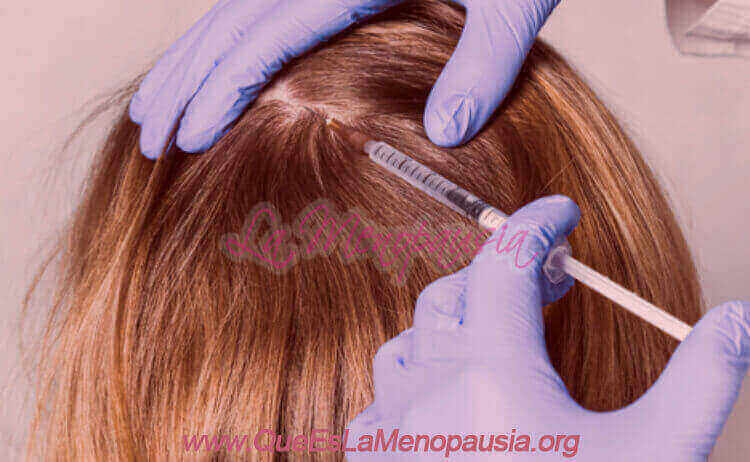 Microinyecciones de dutasterida para la alopecia femenina