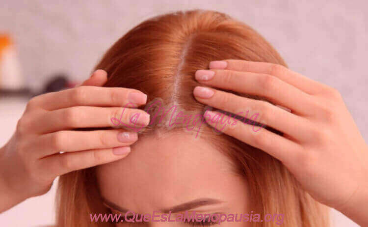 Minoxidil para la alopecia en la mujer