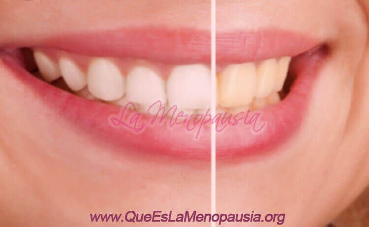 Efectos de la menopausia en encías y dientes