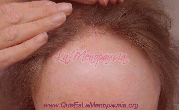 Alopecia Frontal Fibrosante en Mujeres