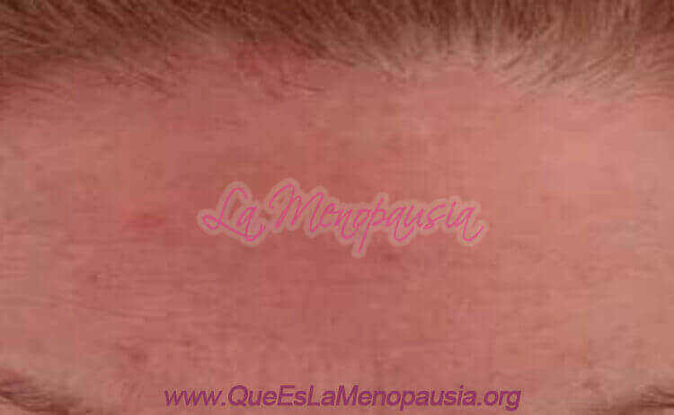 Alopecia frontal fibrosante Causas