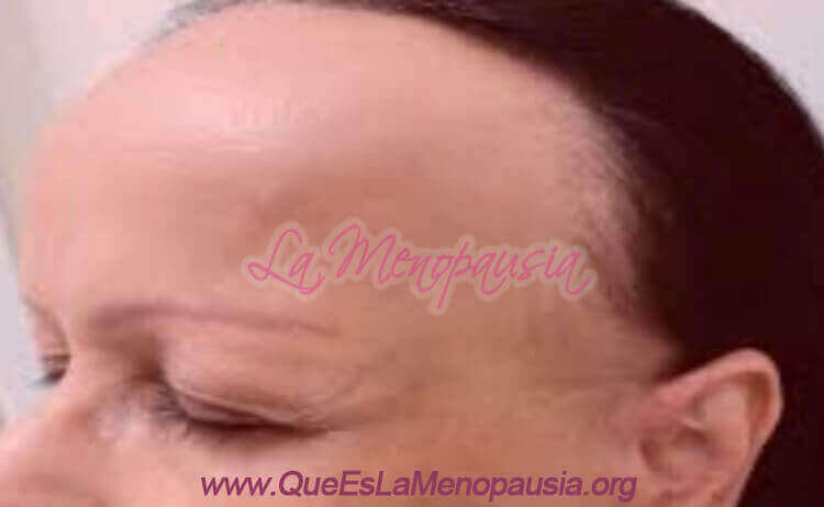 Alopecia frontal fibrosante Fotos 2