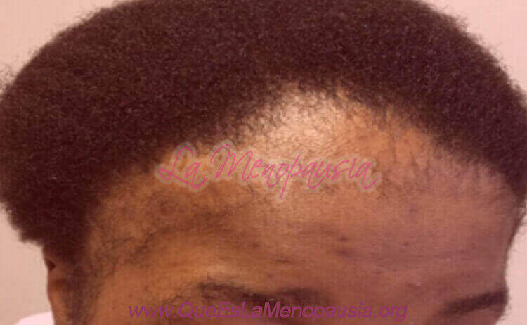 Alopecia femenina fibrosante Fotos 4
