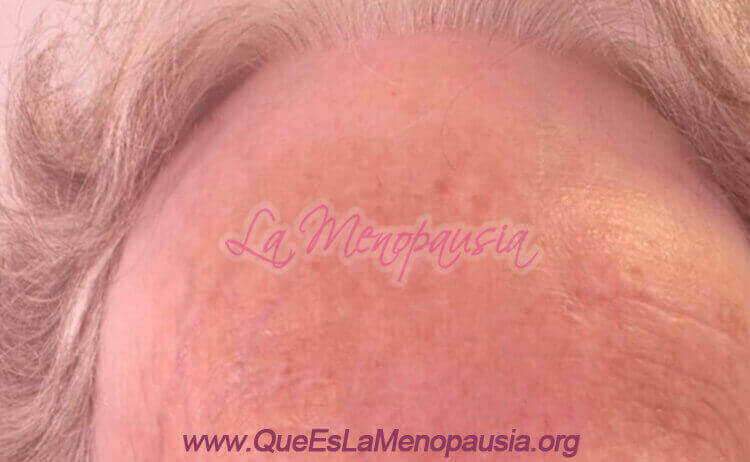 Alopecia fibrosante Fotos 5