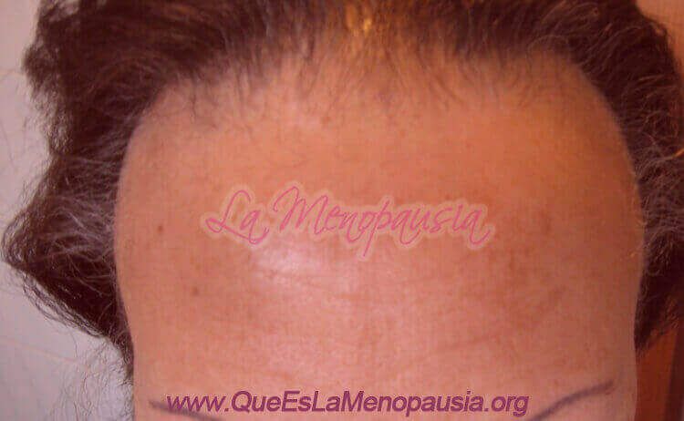 Cómo prevenir la alopecia frontal femenina