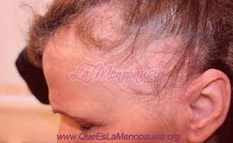 Otras opciones de tratamiento para la alopecia fibrosante