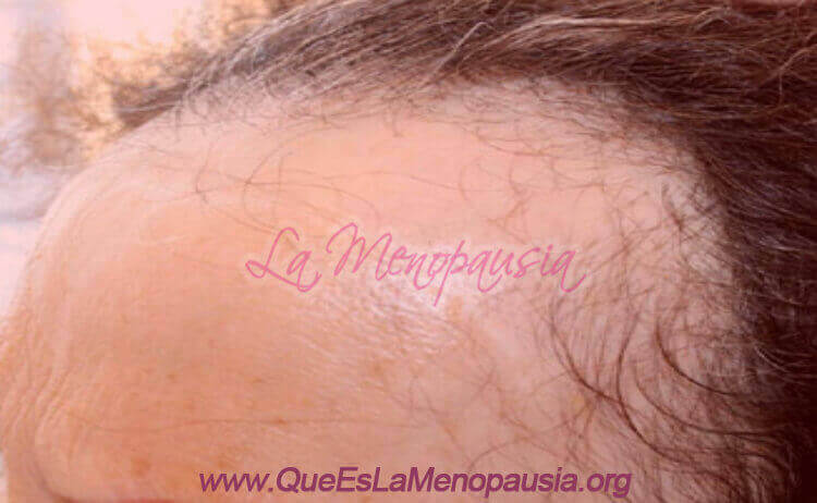 Qué es la alopecia frontal fibrosante