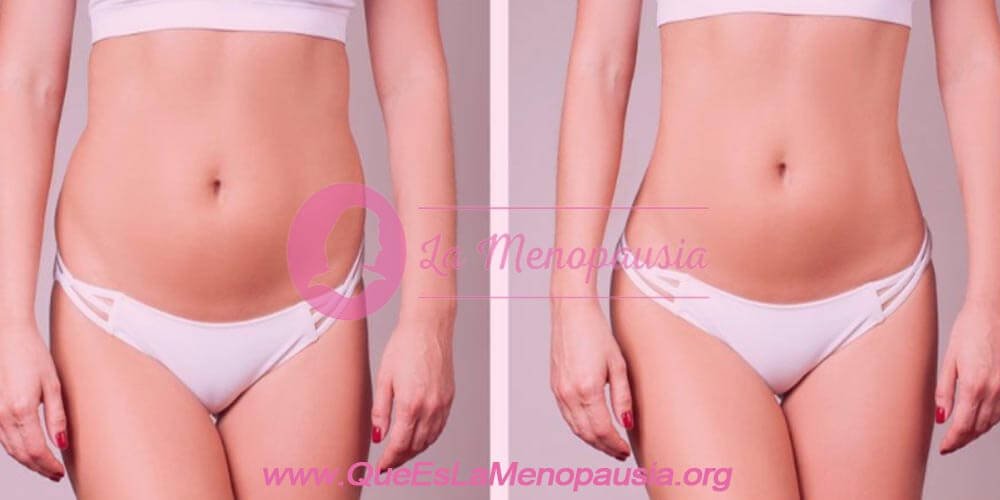 BodyTite: Liposucción sin cirugía, elimina la grasa y flacidez sin cicatrices 2 ¿Qué es BodyTite?