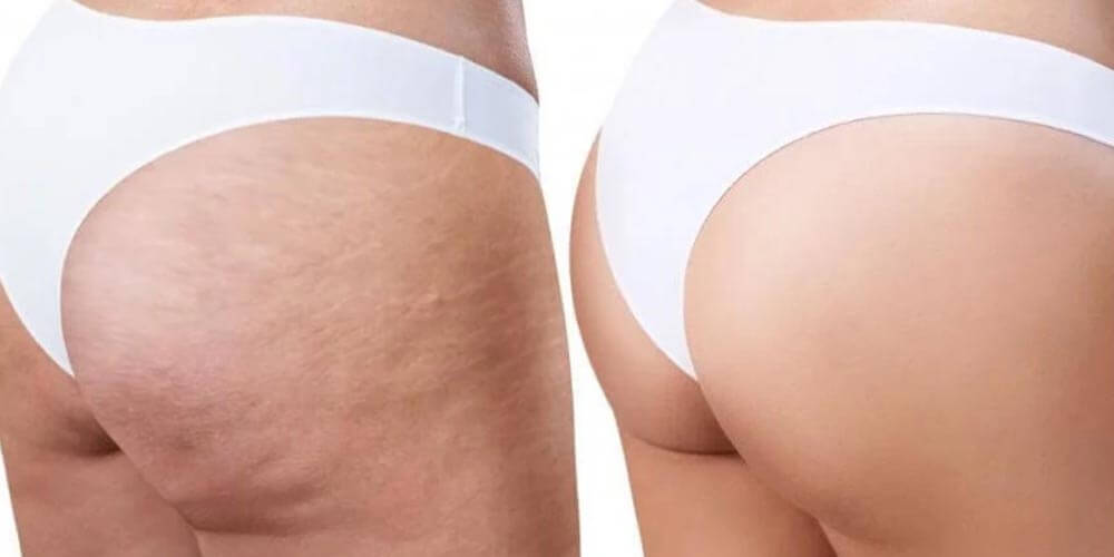 ¿Cómo la lipasa puede reducir la celulitis y la adiposidad de forma efectiva? 4 Beneficios estéticos de la lipasa