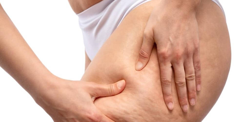 ¿Cómo la lipasa puede reducir la celulitis y la adiposidad de forma efectiva? 6 Consideraciones médicas y recomendaciones