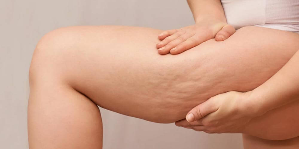 ¿Cómo la lipasa puede reducir la celulitis y la adiposidad de forma efectiva? 5 Innovaciones en el uso de enzimas en cosmética