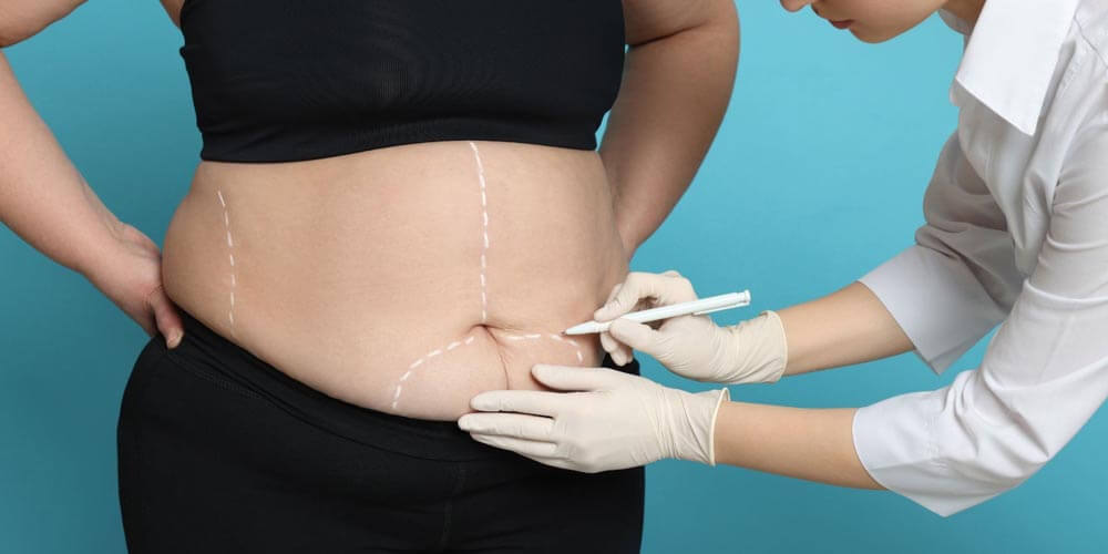 Qué es la cirugía bariátrica y cuándo se recomienda 3 Tipos más comunes de procedimientos